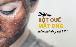 Thực hư mặt nạ mật ong quế trị mụn trứng cá