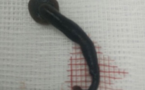 Con vắt dài 5cm sống trong họng người phụ nữ