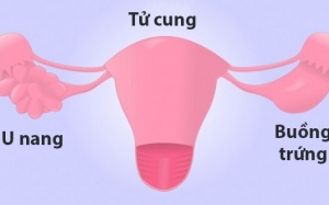 6 suy nghĩ sai thường gặp về hội chứng buồng trứng đa nang