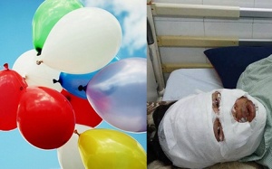 Cảnh báo: Mù mắt, bỏng toàn bộ mặt do nổ bóng bay