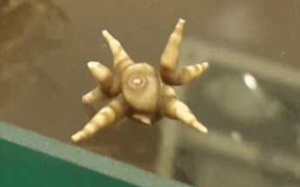 Sốc với hình thù siêu kì dị của viên sỏi bàng quang