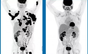 Bệnh nhân ung thư hồi phục kỳ diệu nhờ biến đổi gene