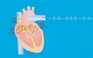 Chú ý 6 nguy hiểm tiềm ẩn với người bệnh rung nhĩ