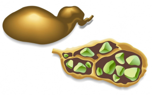 Nguy cơ sỏi mật tăng cao sau phẫu thuật cắt bỏ đại tràng