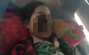 Thiếu nữ 18 tuổi bị phá hủy khuôn mặt sau khi nhổ 1 chiếc răng và đây là nguyên nhân