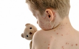 Cha mẹ cẩn thận nhầm lẫn giữa sởi và thủy đậu ở trẻ nhỏ