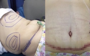 Cắt phăng 2 tảng mỡ bụng để giảm cân có nguy hiểm?