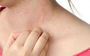 Những điều cần lưu ý khi bị sốt phát ban ở người lớn