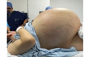 Mang u nang buồng trứng nặng bằng 10 bé sơ sinh