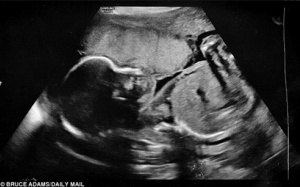 Thai nhi gặp nạn, mẹ uống 4 lít nước mỗi ngày và kết quả không thể ngờ