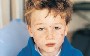 Chăm sóc trẻ bị thủy đậu như thế nào?