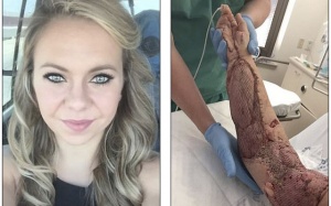 Kỳ diệu cánh tay nát bươm được hồi sinh