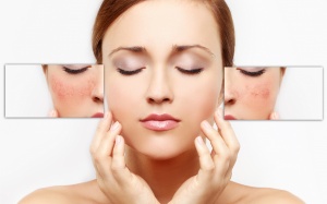 Giao mùa, da nhạy cảm nổi mụn chi chít phải làm sao?