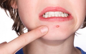 Điệu trị mụn bọc bằng những cách tự nhiên