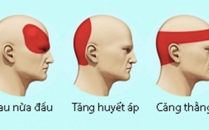 Loại bỏ cơn đau đầu không dùng thuốc trong 5 phút