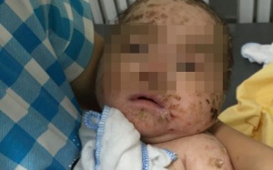 Tắm lá chữa thủy đậu, bé trai 4 tháng tuổi bị nhiễm độc da toàn thân