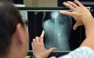 Tim lệch sang phải do bị 5kg bã tích trong ruột