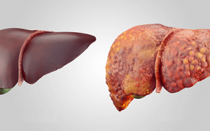 Infographic: Bạn đã biết các dấu hiệu cảnh báo xơ gan?