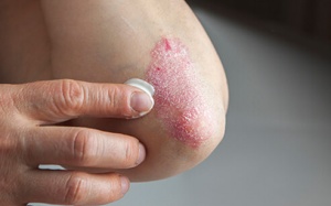 Người bệnh vẩy nến cần chú ý đến 6 thành phần này!