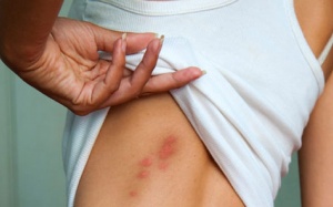 Bị giời leo có nên đắp đỗ xanh và gạo nếp?