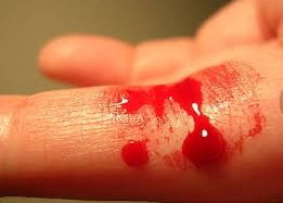 Các biện pháp phòng ngừa hemophilia nặng lên