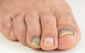 6 'thủ phạm' có thể khiến móng chân thâm đen