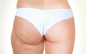 6 lý do khiến da đùi sần sùi như vỏ cam