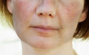 8 điều cần biết về bệnh lupus
