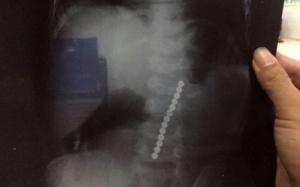 13 viên bi xếp dãy dài trong dạ dày bé 2 tuổi