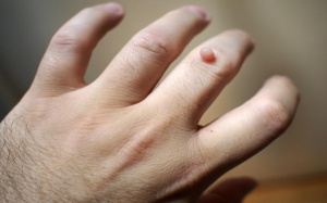 4 cách tự nhiên giúp chữa mụn cóc ngay tại nhà