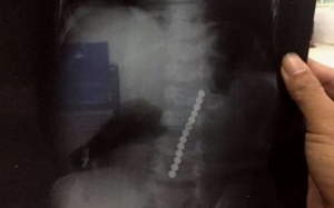 Bất ngờ với chuỗi 13 hạt nam châm trong dạ dày bé trai 2 tuổi