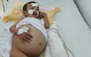 “Coi chừng” teo đường mật khi trẻ vàng da quá 15 ngày