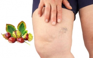 6 lợi ích của hạt dẻ ngựa với bệnh suy giãn tĩnh mạch