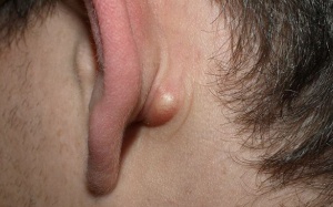 Mọc mụn, u ở tai nguy hiểm như thế nào?
