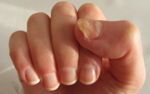 5 nguyên nhân khiến móng tay ngả vàng