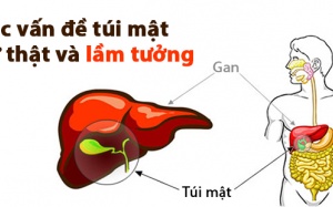 Một vài quan niệm sai lầm về các vấn đề túi mật