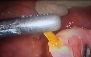 Mục sở thị quá trình lấy xương cá dài 4cm đâm thủng ruột non