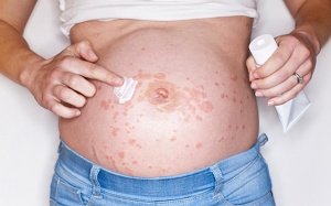 Những vấn đề về da thường gặp khi mang thai và cách khắc phục