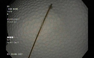 Tưởng đau dạ dày hoá tăm nhọn “ngự” lâu năm không biết