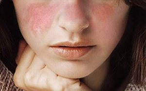 Nổi ban cánh bướm hai bên má có phải mắc lupus ban đỏ?