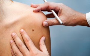 Cẩn trọng với nắng Hè: Quy tắc ABCDE nhận diện ung thư da