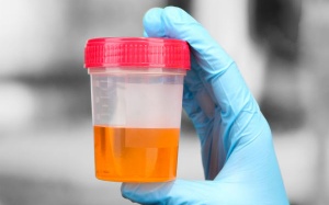 Nước tiểu đậm màu do đâu?