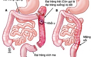 [Inforgraphics]: Phòng ngừa ung thư đại trực tràng hiệu quả