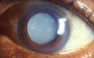 Đục thủy tinh thể do thuốc corticoid phải làm sao?