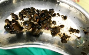 Hàng chục viên sỏi “chất đống” trong đường mật người bệnh