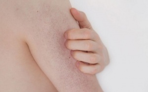 Da sần sùi, khô ráp: Có thể bạn đang mắc dày sừng nang lông