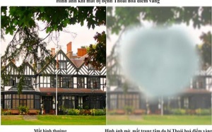 5 nguyên nhân thường gặp gây bệnh về võng mạc