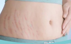 Bộ sản phẩm Babolica có tốt cho người bị rạn da sau sinh?