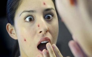 Đoán bệnh qua vị trí mụn mọc trên mặt