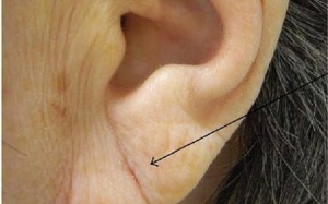 Vết lằn chéo ở dái tai, dấu hiệu cảnh báo nguy cơ cao dẫn tới đột quỵ